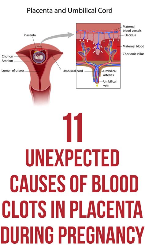 If there is a threat of a miscarriage, in addition to vaginal bleeding you may notice the following: Passage of <strong>bloody</strong> or white-pink mucus material. . Passing blood clots in early pregnancy stories